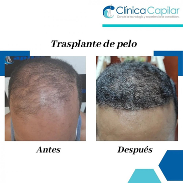 Slider image (7) Clinica Capilar